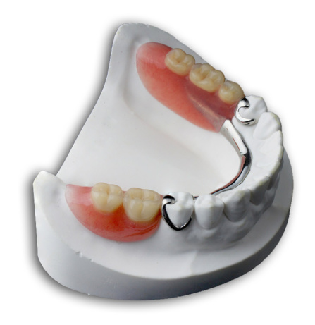 Les prothèses dentaires amovibles Les prothèses dentaires amovibles