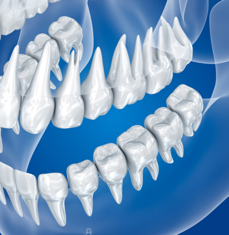 Les dents de sagesse Les dents de sagesse