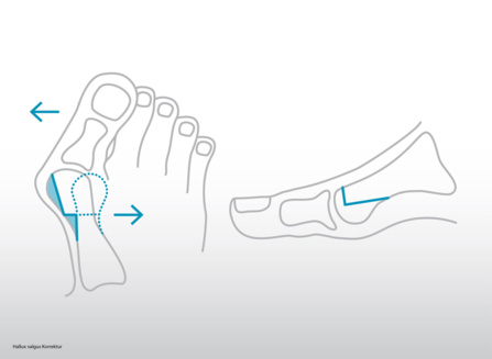 Traitement hallux valgus