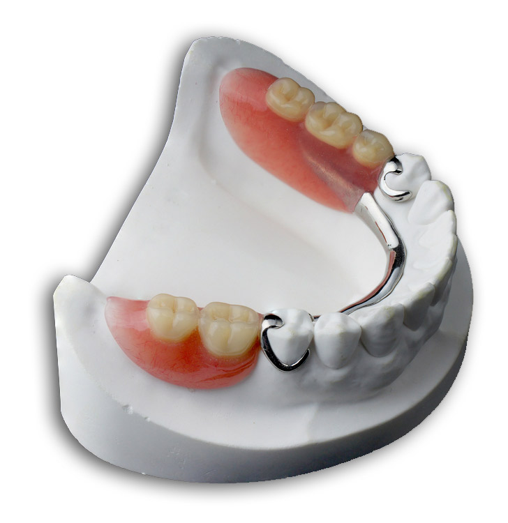 Prothèse Dentaire Amovible Dents - Un Dispositif Remplaçant Une Ou Plusieurs Dents Manquantes.