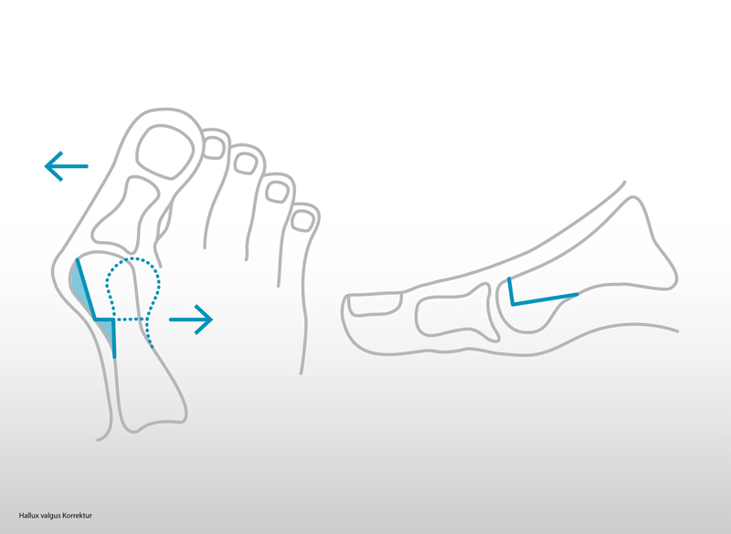 Traitement hallux valgus