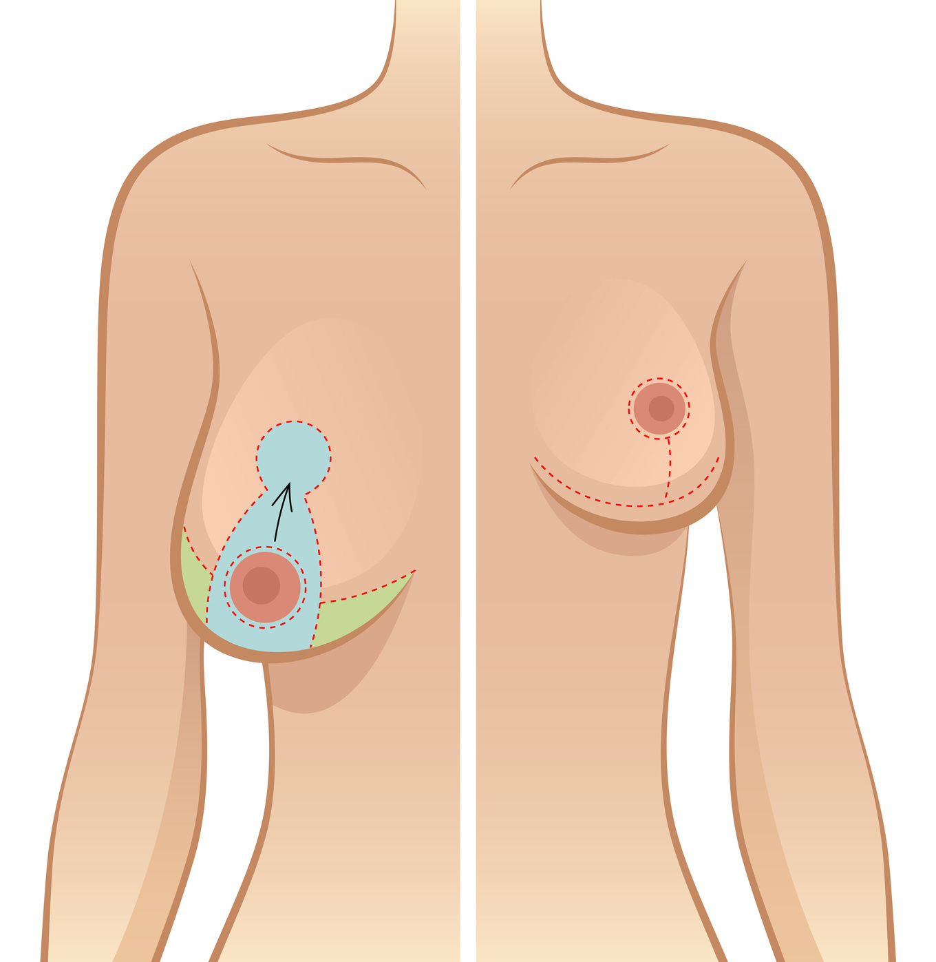 Remodelage des seins et réduction mammaire