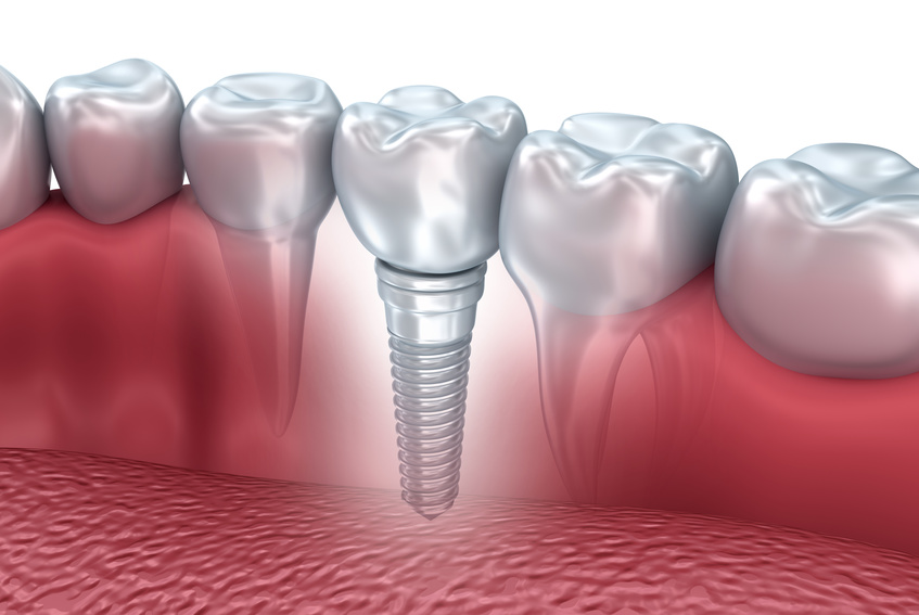 L'implant dentaire
