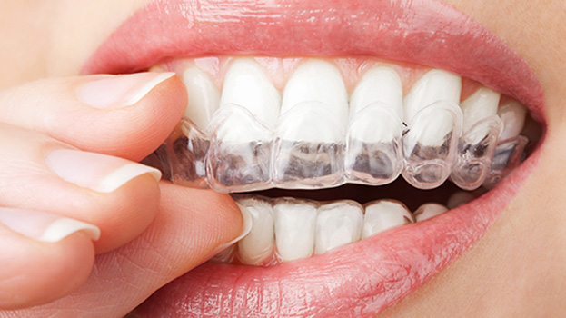 traitement d’orthodontie avec gouttière dentaire