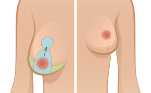 le déroulement d’une réduction mammaire