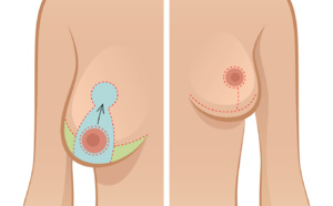 le déroulement d’une réduction mammaire le déroulement d’une réduction mammaire