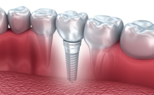 tout savoir sur les implants dentaires