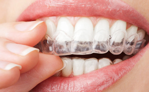 traitement orthodontie par invisalign